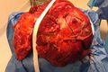 Tumor 25,5 kg terangkat dari pasien 65 tahun