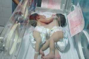 Bayi kembar siam Natalia & Natasya akhirnya meninggal