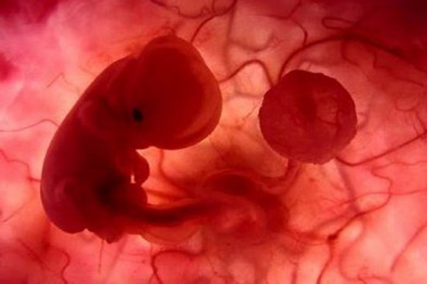 Mahasiswi aborsi, kepala bayi tertinggal dalam rahim