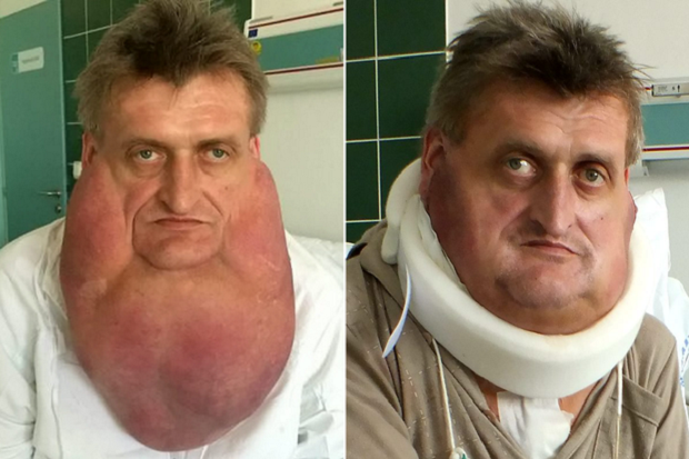 Tumor 6 Kg Diangkat, Pria Slovakia Bisa Noleh setelah 10 Tahun