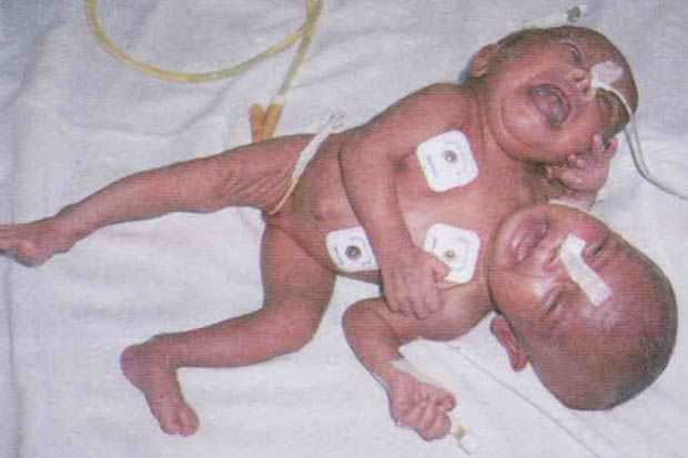 Rahma Bayi Kembar Siam Meninggal di RSUD dr Soetomo