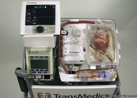 Transplantasi dengan Jantung Mati