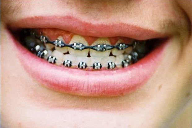 Tak Rutin Kontrol, Penggunaan Kawat Gigi Bisa Berbahaya