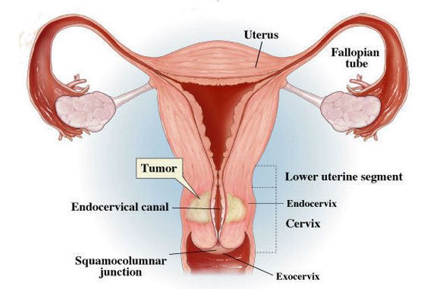 Kenali Gejala Kanker Leher Rahim