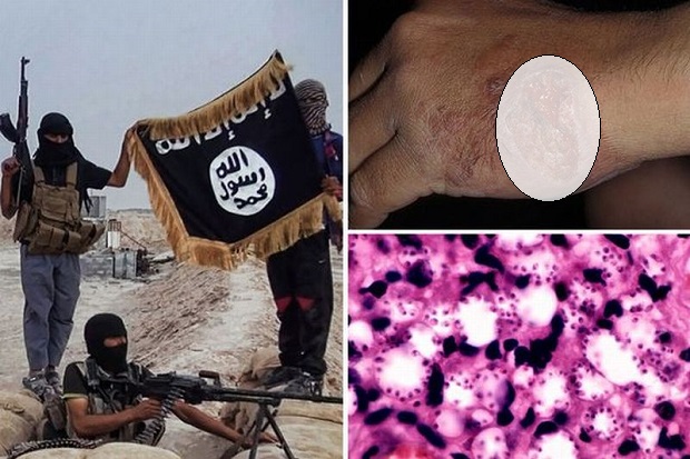 Personel ISIS Diserang Parasit Pemakan Daging