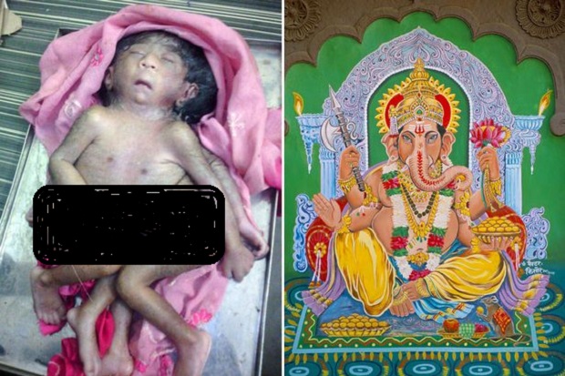 Bertangan 4 & Kaki 4, Bayi Ini Dicap Reinkarnasi Dewa Ganesha