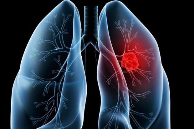Kanker Paru-paru Tidak Hanya Disebabkan Rokok