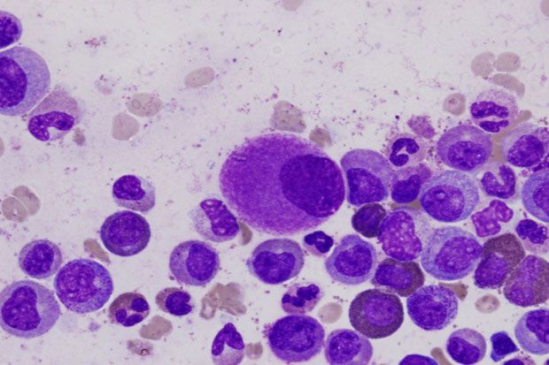 Chronic Myeloid Leukemia, Kanker Darah Langka di Dunia