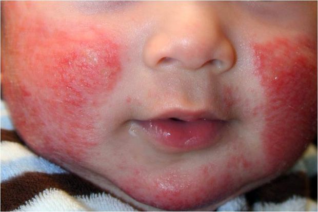 Waspadai Gejala Anak Alergi Protein Susu Sapi Berikut Ini