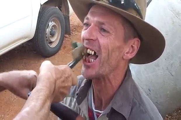 Horor, Dokter Pedalaman Australia Cabut Gigi dengan Tang
