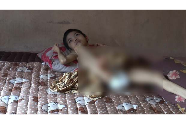 Indah Gadis Kecil Asal Nagan Raya Aceh yang Menderita Lumpuh Layu