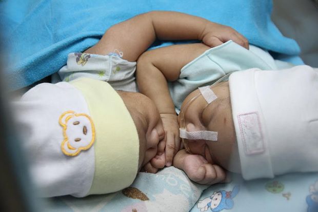 RSHS Rawat Bayi Kembar Siam asal Ciamis