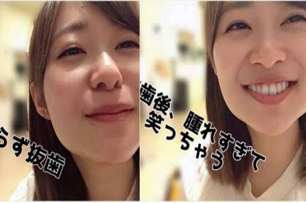 Alasan Sashihara Rino AKB48 Lakukan Operasi Gigi
