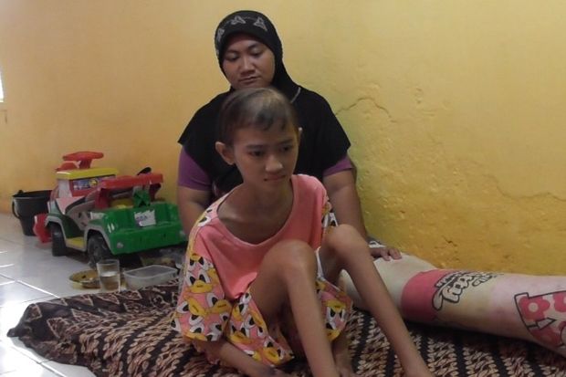 Menderita Osteosarcoma, Siti Khadijah Butuh Uluran Tangan Dermawan