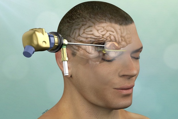 Metode Operasi Tumor Otak Melalui Alis Mata