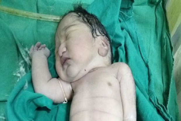 Bayi Putri Duyung Terlahir di India