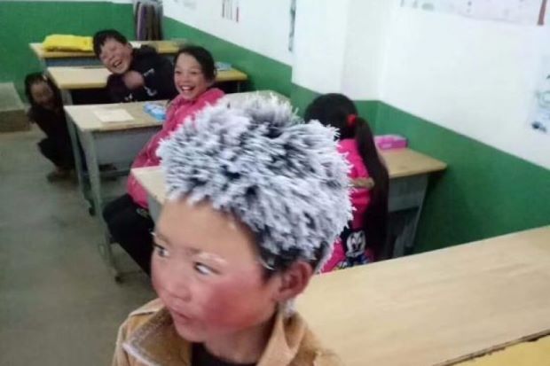 Donasi Rp35 Miliar untuk Perjuangan Bocah China Berambut Es
