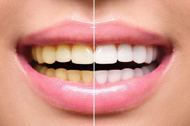 8 Cara Memutihkan Gigi Secara Alami