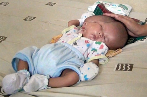 Kelahiran Bayi Dua Wajah di Indonesia jadi Pemberitaan Media Asing