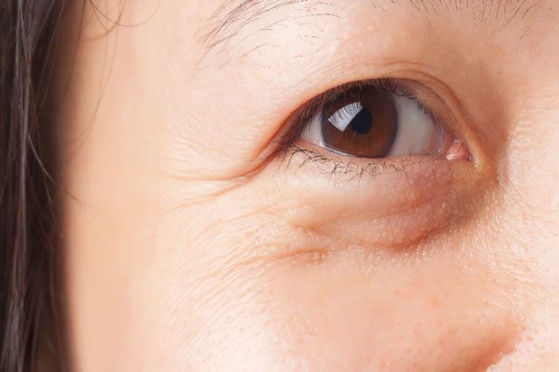 9 Bahan yang Bisa Dipakai untuk Menghilangkan Kantung Mata