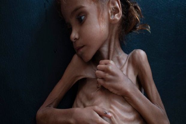 Facebook Blokir Foto Gadis Kelaparan di Yaman, Publik Marah