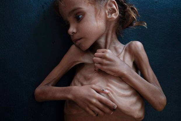 Gadis Cilik Simbol Krisis Kemanusiaan di Yaman Meninggal