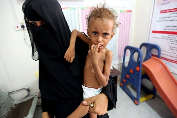 Sudah 85.000 Anak Yaman Mati Kelaparan akibat Perang