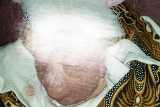 16 Hari Dirawat di RS, Bayi Lahir Tanpa Batok Meninggal Dunia
