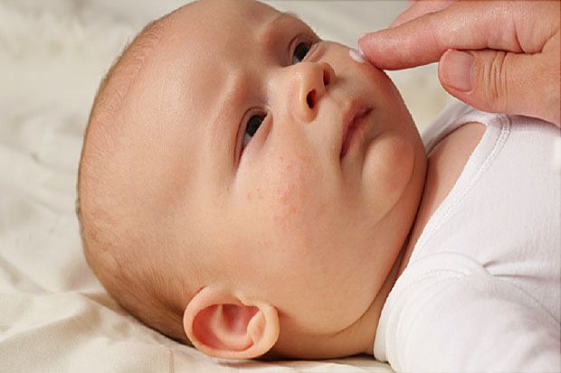 Eksim pada Bayi Bikin Anak Rentan terhadap Alergi dan Asma