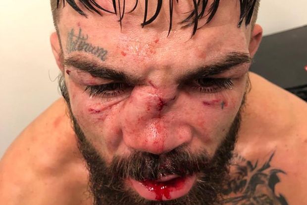 Duel Brutal, Petarung UFC Alami Cedera Hidung Paling Mengerikan dalam Sejarah