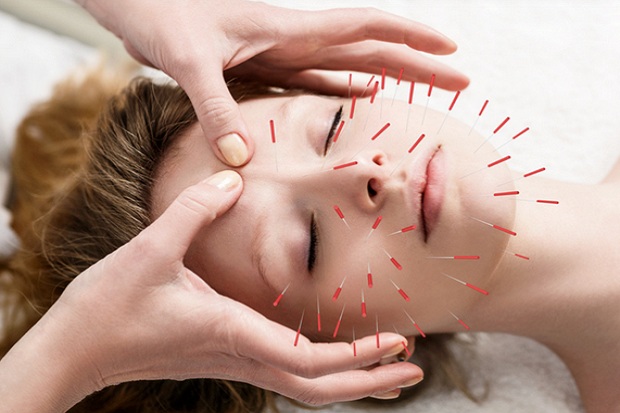 Mengapa Suka Merasa Pusing Setelah Melakukan Perawatan Akupunktur?