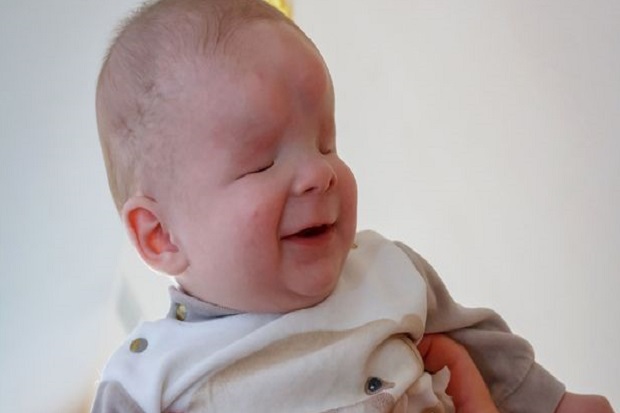Bayi Laki-laki di Rusia Terlahir Tanpa Mata, tapi Kerap Tersenyum