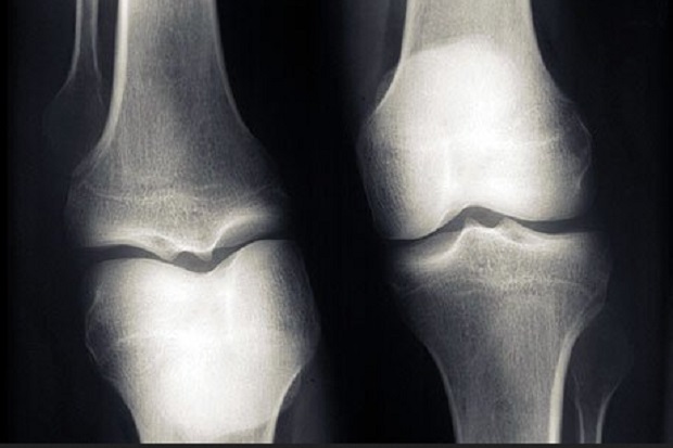 Kenali Risiko dan Gejala Osteoporosis, Biar Tulang Tak Mudah Keropos