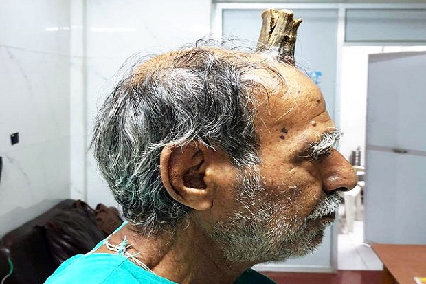 Tanduk Setan Setinggi 10 Cm Tumbuh di Kepala Pria India Dioperasi