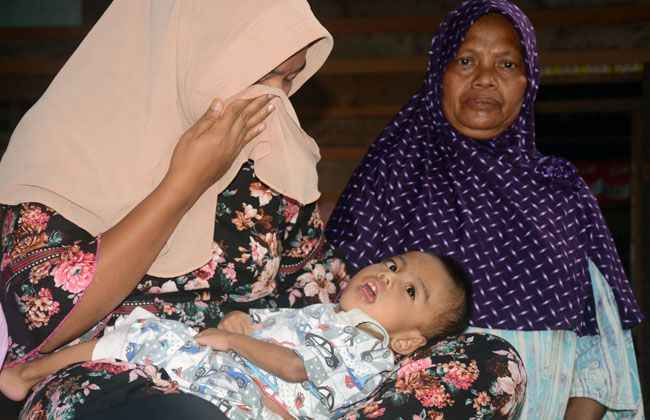 Selain Gizi Buruk, Hanif Bayi 2 Tahun Kota Padangsidimpuan Alami Kebutaan